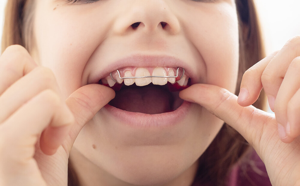 子どもの頃に歯並びを矯正する理由
