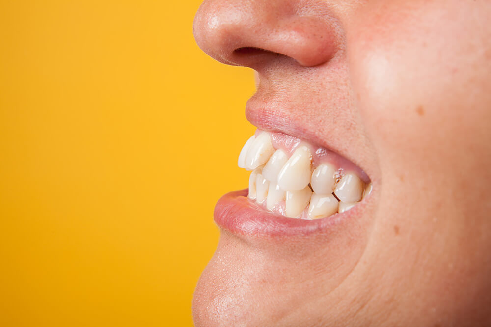 顎関節症の方、歯の数が少ない方、咬合力が強すぎる方